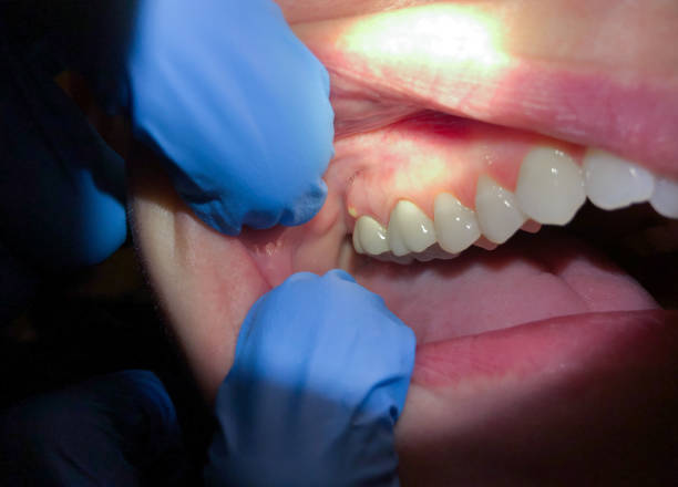 Best Emergency Root Canal Treatment in Richmond, VA