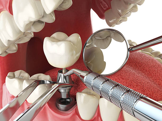 Best Emergency Dental Extractions in Richmond, VA